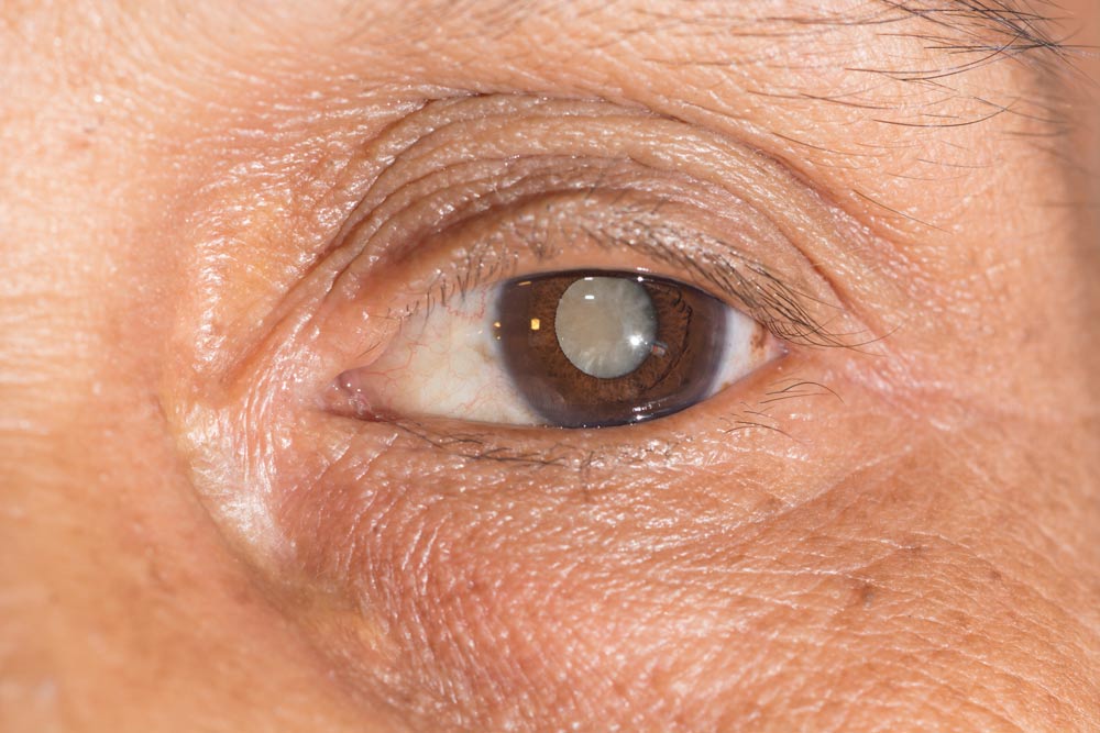 Cataracts Screening